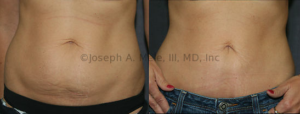 The Mini Tummy Tuck can clean up loose skin and lax muscle and disproportionate fat on the lower abdomen without the downtime of a full Abdominoplasty.