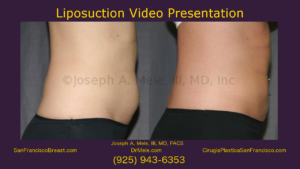 Liposuction Video Presentation with Liposculpture Before and After Pictrures