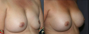 When breast implant remain deflated for a long time, the skin and the pocket around the implant often shrink. This before and after picture show improved symmetry after breast implant replacement surgery.