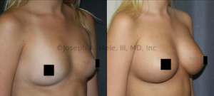 Breast Augmentation remains one of the most popular cosmetic plastic surgery procedures, but what is the recovery like after Breast Implants?