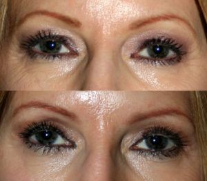 The above upper and lower blepharoplasty (quad bleh) before and after photos reveal improvements in the upper and lower eyelids' appearance. Less upper eyelid skin means smoother, cleaner lines and that eye makeup stays put better. Lower eyelid improvements include smoother appearance and less bagging of both skin and lower eyelid fat.