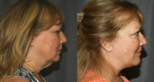 Before and After Facelift as seen from the side.