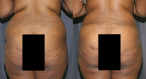 Liposculpture was used to contour and remove excess fat above and below the buttocks. The fat was then grafting into the buttocks to provide additional fullness.