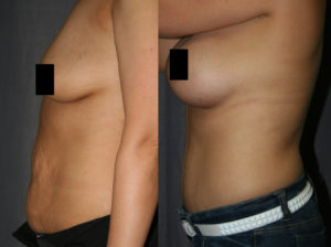 This Mommy Makeover is the most popular combination of Tummy Tuck (Abdominoplasty) and Breast Augmentation (Breast Implants).