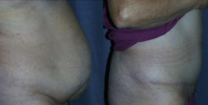 With severe muscle laxity, diet, exercise, even Liposuction is futile. The Tummy Tuck is the only way to fix this.