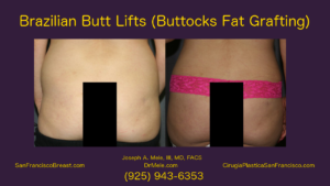 Brazilian Buttocks Lift with buttocks fat grafting before and after pictures