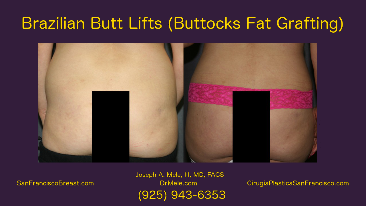 Buttocks Augmentation Video - Brazilian Butt Lifts and Fat Grafting