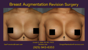 Breast Implant Revision Surgery Video with before and after pictures symmastia