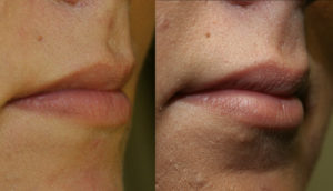 Today Lip Augmentation is dominated by injectables. Fillers like Restylane, Juvederm and Perlane, where performed a few million times last year in the US for Lip Augmentation and the treatment of facial wrinkles in the US last year. Second in number only to Botox for all non-surgical cosmetic procedures.