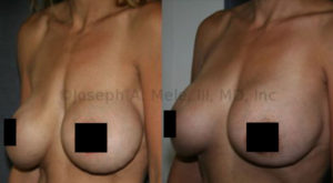 Severe Bottoming-Out: Breast implant revision surgery before and after pictures of the correction of severe bottoming-out with an internal lift. No additional exterior incisions where needed to provide correction.