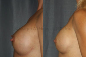 Mild Bottoming Out: Most the volume of the breast implant is below the nipple before the breast implant revision surgery. Nipple reduction was also performed.