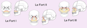 Rene Le Fort documented how the face breaks with severe trauma. In Le Fort I fractures the upper jaw is separated from the face. With Le Fort II fractures the nose and upper jaw are separated from the face. The Le Fort II fracture is separation of all the facial bones from the skull. All Le Fort fractures are worth avoiding, and less likely of you wear your seat belt.