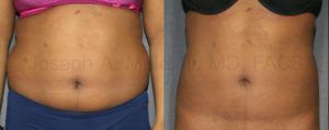 Liposuction of the abdomen can be extended around the sides and back to remove the love handles and muffin top.