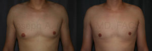 Liposuction is sometimes all that is needed to smooth out stubborn man boobs (moobs). If the fullness is due to fat and the area under the nipples is soft, liposuction may be the cure.