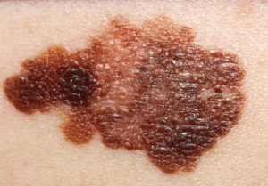 The Typical Melanoma has: A) Asymmetry; B) Borders that are irregular and not smooth; C) Colors that vary from red, white to blue; D) Diameter that is changing in size. These are the ABCD's of melanoma.