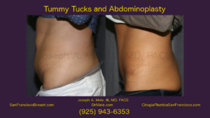 Tummy Tuck Video with Abdominoplasty before and after pictures
