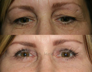 Upper Blepharoplasty removes excess skin and fat from the upper eyelids, providing more rested and alert appearance.