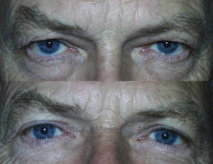 Before upper and lower blepharoplasty with enhancement of the lower eyelid support. removing the excess fat and skin without the lid tightening procedure would expose more of the white of the eye breath the iris. Instead, the lower eyelid is supported and moves up to its ideal position.