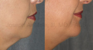 A strong female chin still looks feminine, and helps to define the border between the face and neck.