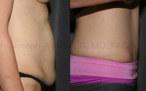 The Tummy Tuck provides excellent cosmetic results, but there may be medical benefits also.