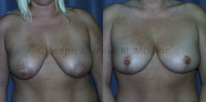 Vertical breast lift before and after pictures shows how the lift elevates the breasts and the nipple and reduces the areolae more effectively than the periareolar lift can.