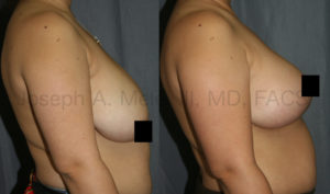 Breast lift before and after pictures show lifting of the nipple and breast tissue from the side. This makes the breasts perky and youthful.