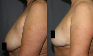 Inverted-T or Anchor Breast Lift Before and After. The IMF incision is hidden in the fold under the breast. Out of site. Out of mind.