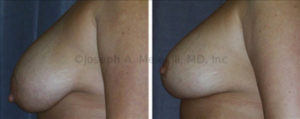 The woman above fails the pencil test and her nipples are lower then the fold under her breasts. She fails the Pencil-Plus Test and needs a Breast Lift to provide a more aesthetic result.