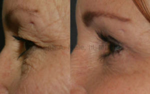 Eyelid lifts remove excess skin and fat from the eyelids, revealing a smoother, rested and more alert appearance.