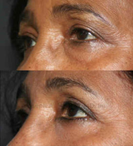 After blepharoplasty, the upper eyelid crease is singular and more defined, while the lower eyelid bags have been removed.