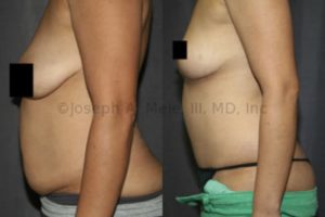 In the above Mommy makeover a Tummy Tuck is combined with a Breast Lift. When the size of the breast is satisfactory, and the main problem is sagging, a breast lift can restore the breasts' shape without making them bigger.