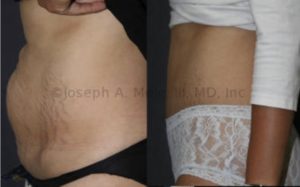 Mommy Makeovers repair breasts and bellies. Above a Tummy Tuck is used to flatten and tighten a post baby belly.