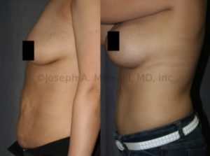 The most common Mommy Makeover combination is the one depicted above: Breast Augmentation and a Tummy Tuck. Breast