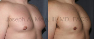 Gynecomastia Reduction is performed in several ways. Often a combination of Liposuction for fat removal and direct excision of the firm breast tissue from beneath the nipple is the best combination.