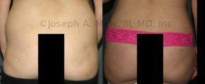 The Brazilian Butt Lift has been on the rise in the US for the last ten years. The techniques allows not only for buttocks enlargement, but for reshaping the buttocks. The before image on the left shows a square buttocks which is asymmetrical, too full up top and yet empty laterally, especially on the left. The after image on the right shows more shapely female buttocks with a rounder fullness, smooth contours and better symmetry. The end result is an hourglass figure.