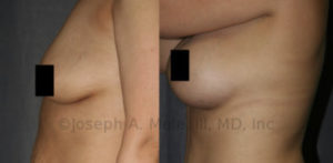 Breast Augmentation depends of the formation of a proper Breast Implant Pocket for the best results.