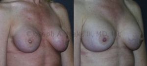 Capsular Contracture results in a compressed breast implant that looks,smaller, felt harder and in the worst case scenario hurts. A capsulectomy and breast implant exchange was performed to provide this patient with softer, larger and less inflamed appearing breasts.