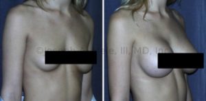 Optimal Breast Enhancement pays attention to both the size and the shape of the breasts. Above Breast Augmentation with Breast Implants is performed to enhance the size of the breasts and even out the asymmetry.