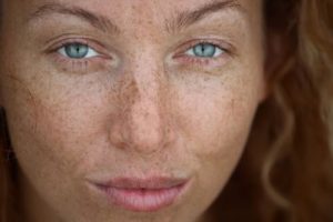 Freckles are sun damage. Without sun exposure, freckles never appear.