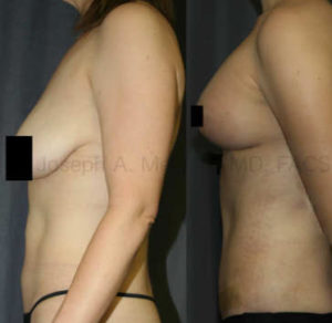 The Mommy Makeover helps by enhancing both the breasts and the belly in a single combination plastic surgery procedure.