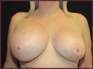 The typical presentation of ALCL is a large serum (fluid collection) around the breast implant causing obvious enlargement and asymmetry of the breast augmentation.