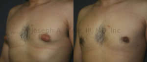 Gynecomastia Reduction: In this case direct excision of the glandular tissue from under the areola not only smooths the chest's contour, but also reduces the apparent size of the areolae -- the pigmented skin that surrounds the nipple. The darker color is simply a result of the same amount of pigment distributed over the new, significantly smaller, area.