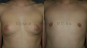 Gynecomastia Reduction: Sometimes the amount of breast tissue on the chest is enough to completely feminize the chest. Liposuction, combined with direct excision of the glandular components, restored the fat chest that this young man is expected to have. Again the reduction in areolae is due to the skin's elastic contraction after the breasts are unstuffed.