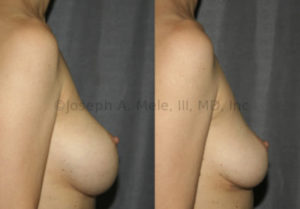 Breast Implant Removal Before and After Pictures: The patient above wanted her Breast Implants removed because she felt too big. She also has some bottoming-out of her breast implants. Her breast implants were removed and a special, inferior-pole lift was performed to reduce the amount of skin hanging below her nipple and to move the native breast tissue that she had back up under the nipple.