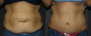 Abdominoplasty Before and After Pictures: The front view of the above Abdominoplasty shows how much the abdominal muscles and skin are tightened. The shadows of the muscles are brought closer to the midline and skin is much smoother. The belly button is also rejuvenated.