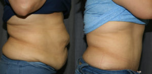 Tummy Tuck Before and After: These side views of Abdominoplasty before and after pictures show what a Tummy Tuck can do to address overstretched abdominal muscles and abdominal skin laxity seen after pregnancy or weight loss.