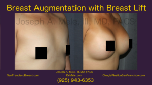Breast Augmentation Lift Video Mastopexy Augmentation before and after pictures