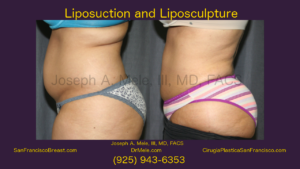 Liposuction Video Presentation with Lipo before and after pictures