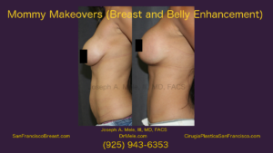 Mommy Makeover Video with Breast Augmentation before and after photos