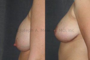 Before: This young woman had Breast Augmentation before pregnancy. After two children, the skin of her breasts relaxed, dropping the breast tissue off her Breast Implants. After: Her Breast Implants were exchanged to adjust volume and a Breast Lift was performed to reshape and rejuvenate her breasts.